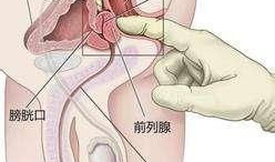 前列腺按摩视频,专业视频解析与操作指南